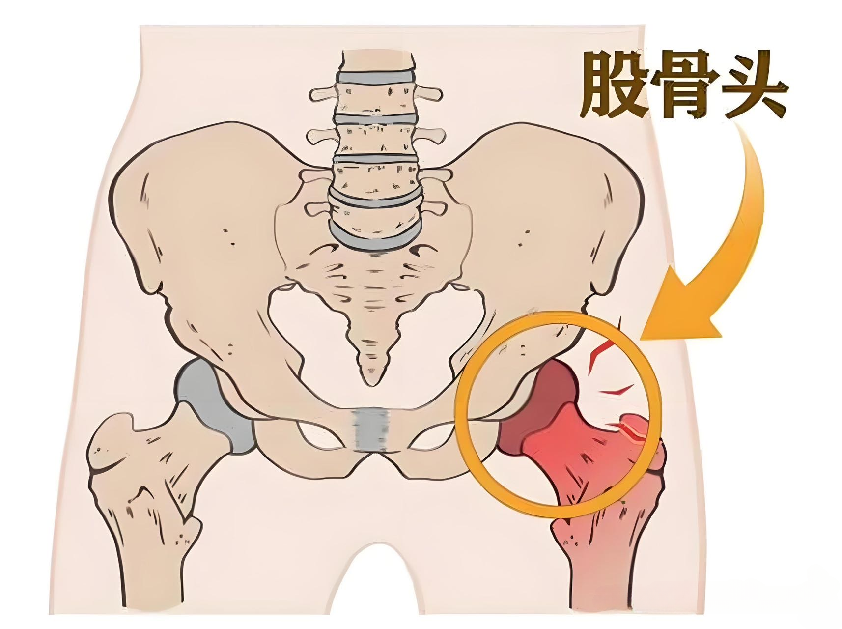 早期股骨头坏死：修复为先、综合施治的恒沃方案